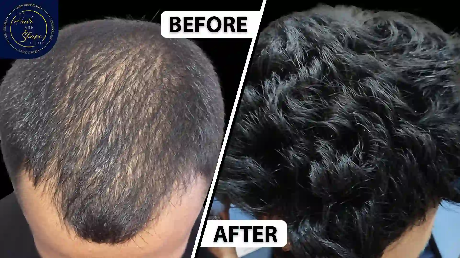 PRP Treatment result1